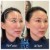 Upper Face Filler treatment 22 thumbnail