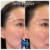 Upper Face Filler treatment 24 thumbnail