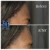 Upper Face Filler treatment 25 thumbnail