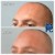 Upper Face Filler treatment 26 thumbnail