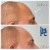 Upper Face Filler treatment 27 thumbnail