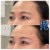 Upper Face Filler treatment 28 thumbnail