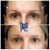 Upper Face Filler treatment 29 thumbnail