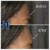 Upper Face Filler treatment 3 thumbnail