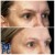 Upper Face Filler treatment 30 thumbnail
