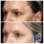 Upper Face Filler treatment 4 thumbnail