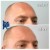 Upper Face Filler treatment 5 thumbnail