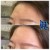 Upper Face Filler treatment 6 thumbnail