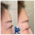 Upper Face Filler treatment 7 thumbnail