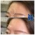 Upper Face Filler treatment 8 thumbnail