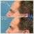 Upper Face Filler treatment 9 thumbnail